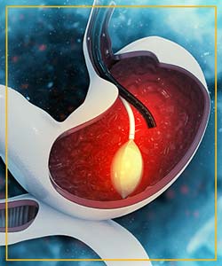 Esophageal/Mucosal Endoscopy in Advanced Gastroenterology of Central Florida