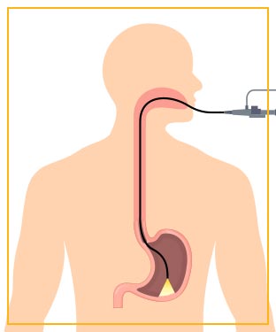 PEG Tube Placement in Advanced Gastroenterology of Central Florida