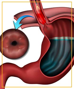 Radiofrequency Ablation in Advanced Gastroenterology of Central Florida