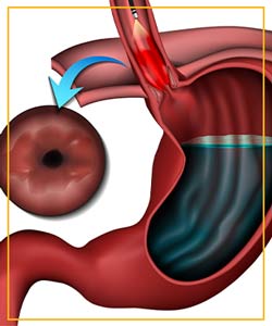 Radiofrequency Ablation in Advanced Gastroenterology of Central Florida